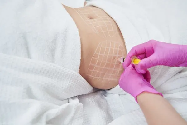 image of fat dissolving injections on love handles to help combat weight gain Camden