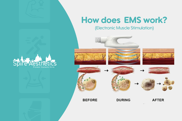 EMS treatment for post pregnancy weight loss treatment Camden