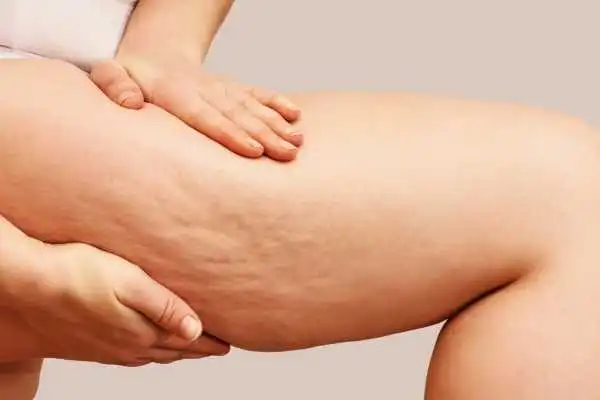 Image of woman showing leg with cellulite Camden