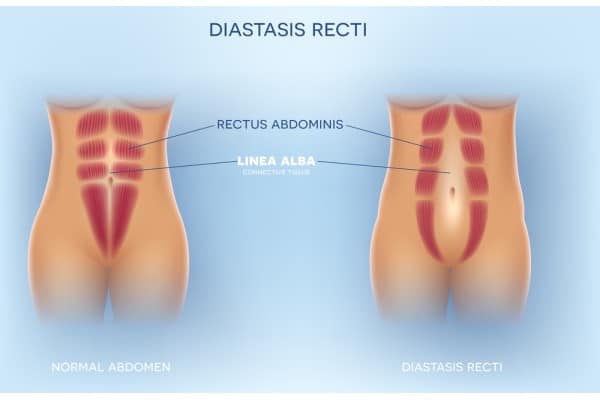 How Does Non-Surgical Treatment Help With Loose Skin, Weak Abdominal Muscles and Post-Pregnancy Changes Camden?