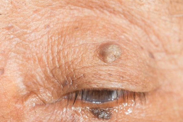 Skin imperfections Camden - Cryopen is fast and effective book in today!