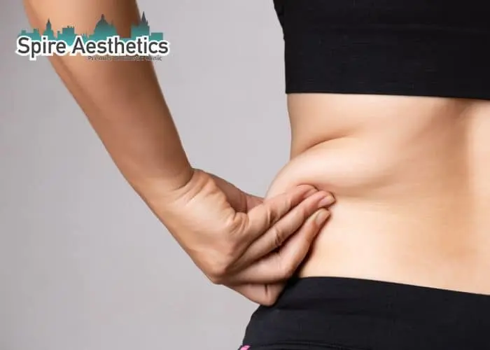 Image of woman pinching fat on their hips Camden. Fat Freezing treatment