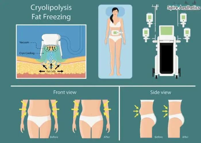 Fat freezing treatment Camden benefits for competitions to remove stubborn fat deposits.