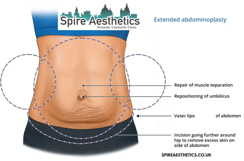 Understanding Loose Skin After Gastric Band Camden Surgery and HIFU Treatment