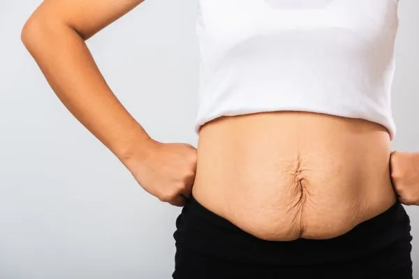 Image of a woman's stomach after weight loss with sagging skin following a gastric band Camden
