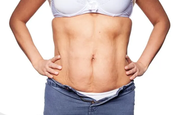 sagging skin on woman's stomach after weight loss injections Camden