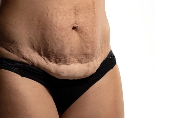 Image of womans stomach after weight loss injections Camden showing saggy skin