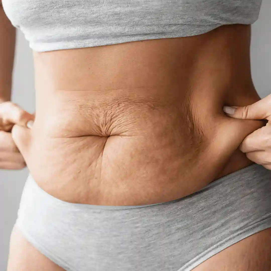 Is It Normal to Have Loose Skin After Pregnancy Camden?