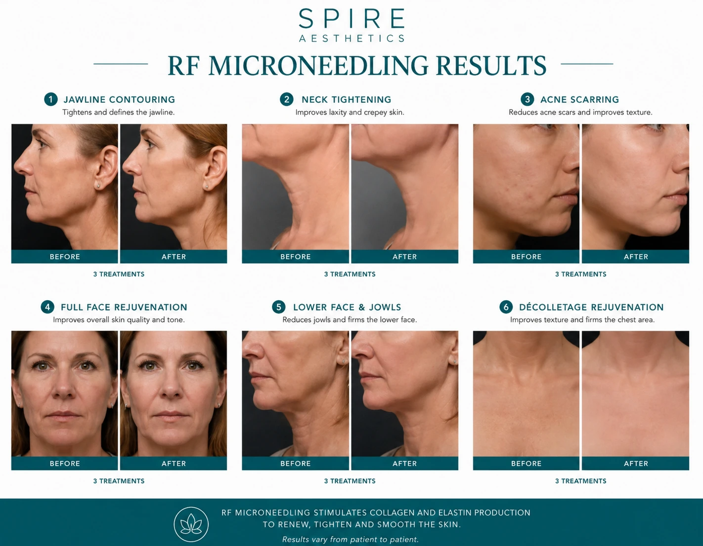RF Microneedling Skin tightening Camden results