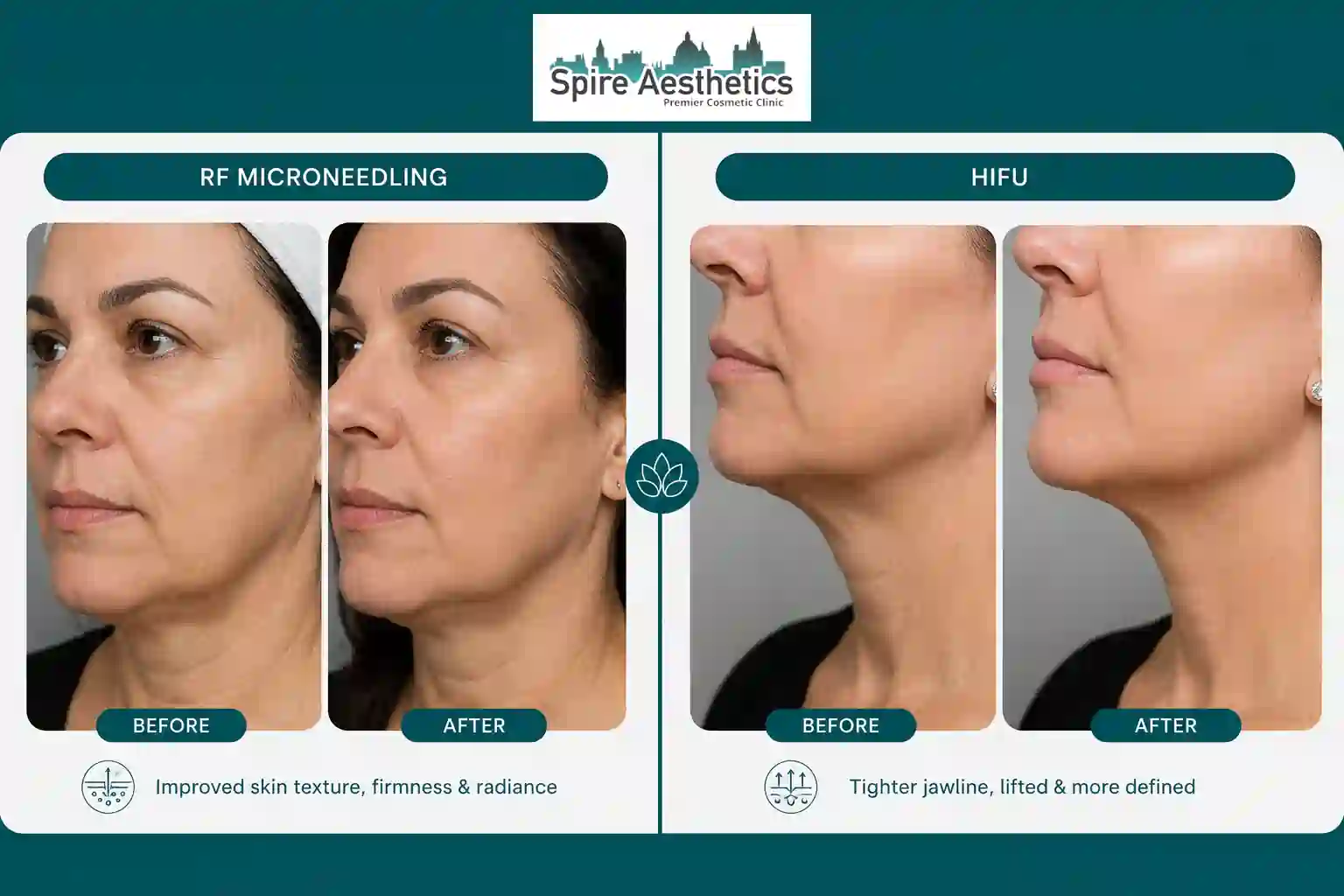Can RF Microneedling and HIFU Be Combined Camden?