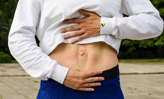 When Could Diastasis Recti Be the Missing Piece of the Puzzle Camden?