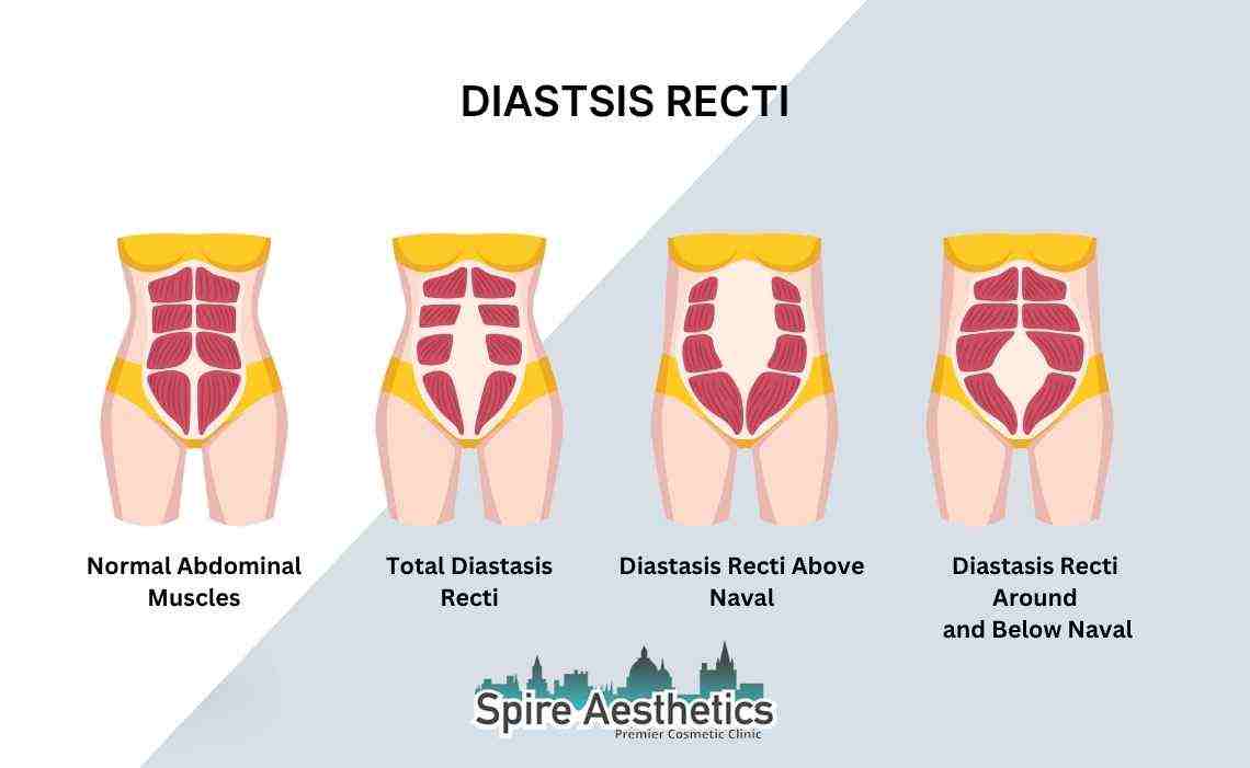 Is Non-Surgical Diastasis Recti Treatment Right for You? Common Concerns Answered Camden